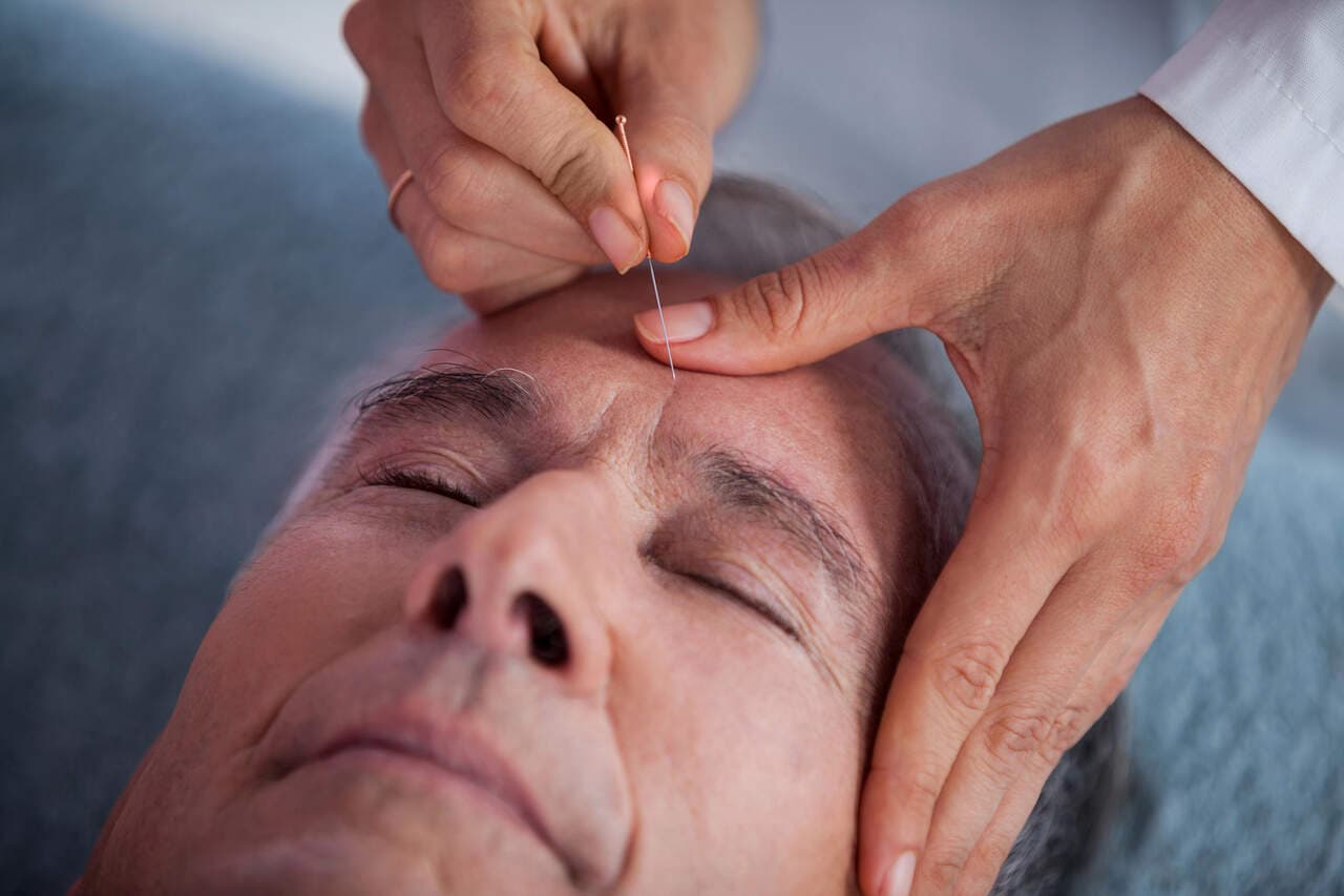 How Acupuncture for Migraines Supports a Headache Diary