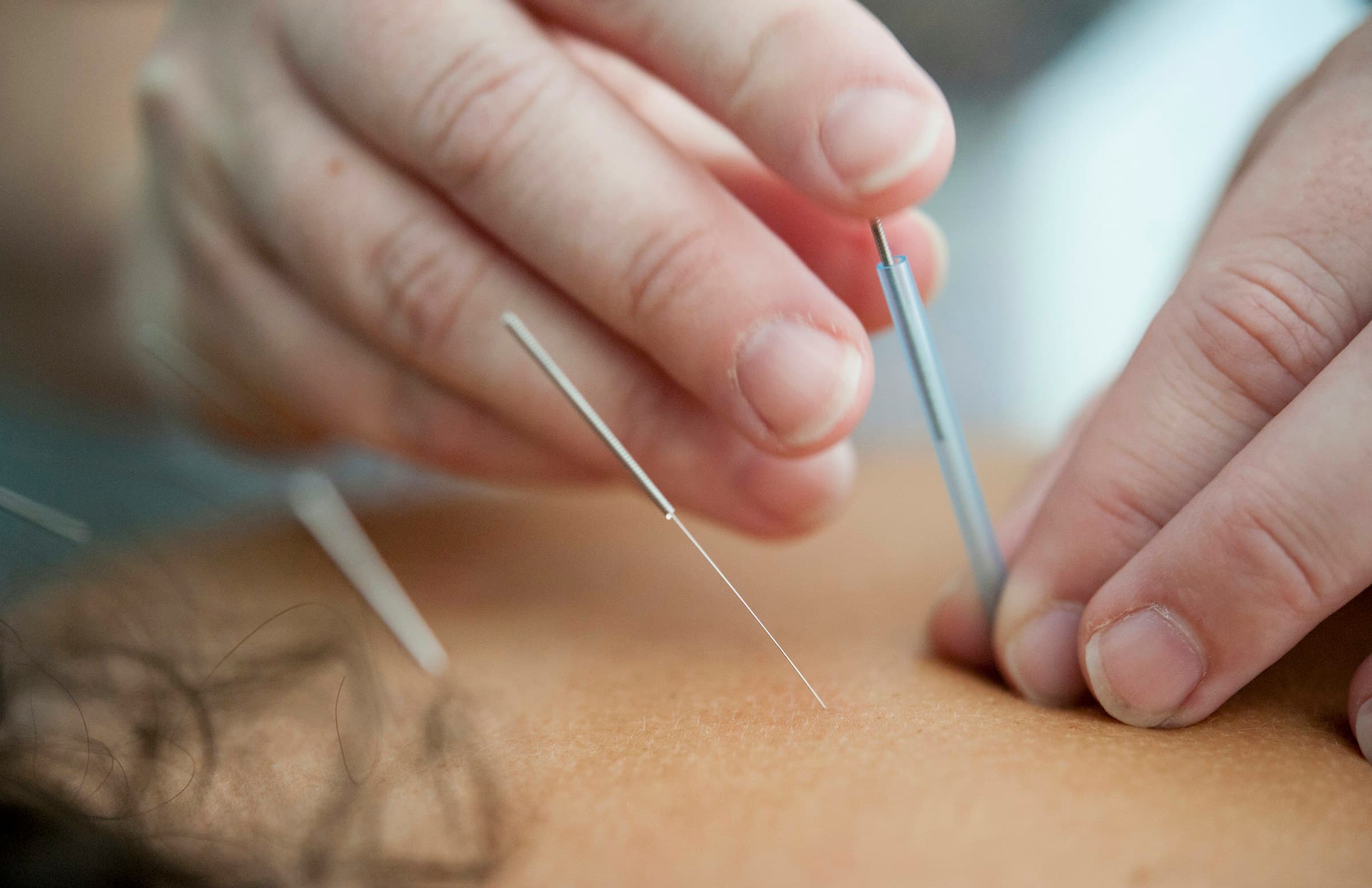 Acupuncture benefits for Charlotte metro patients