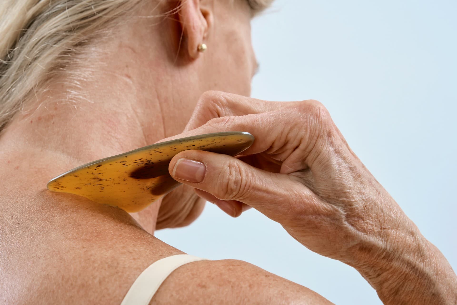 Gua Sha Marks